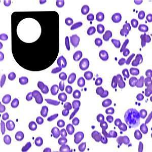 Sickle cell disease: a lethal advantage - for iPad/Mac/PC by The Open University