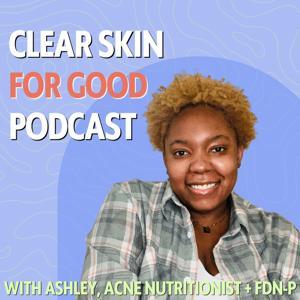 Clear Skin For Good | Tips Clearing Acne Without Cutting Out More Foods by Ashley, Acne FDN-P
